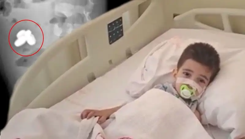 İstanbul'da Mıknatıs ve Pil Yuttuktan Sonra Bağırsağı Yanan Çocuk Hayata Döndü