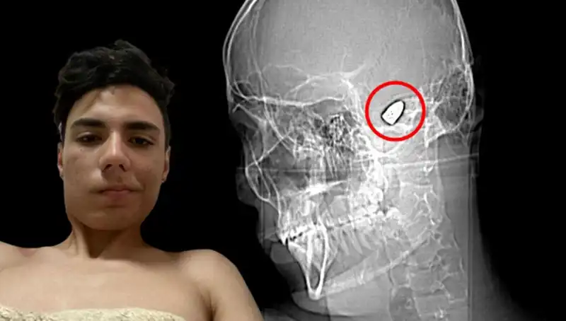 Kafasında Patlamaya Hazır Bir Bomba Taşıyan Genç: Hayatının Korkunç Gerçekleri